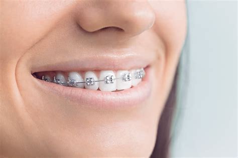 traditional metal braces for adults